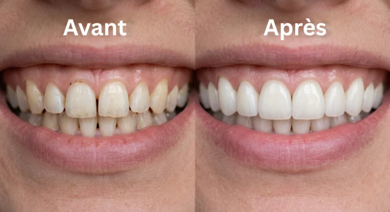 facettes dentaires à agadir